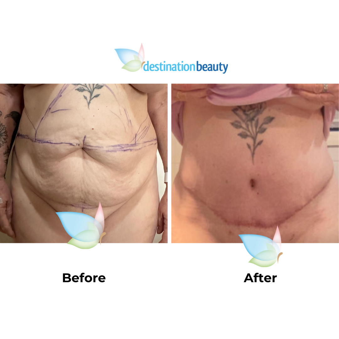 Jane S had extended tummy tuck and liposuction with Dr. Weerachai