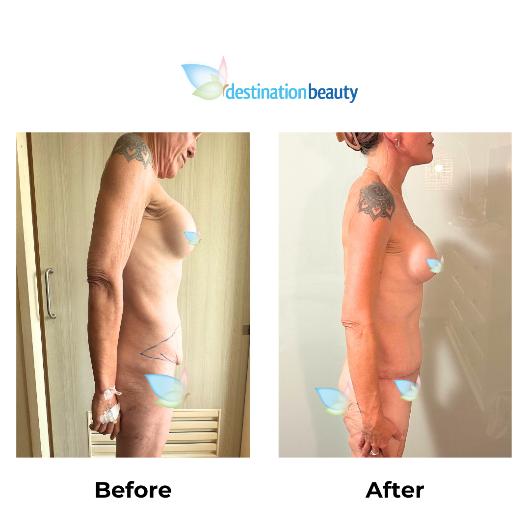 Janene had extended tummy tuck and arm lift in Thailand-3