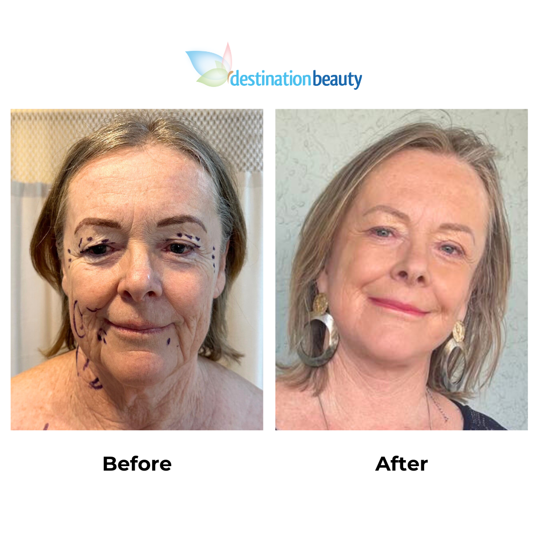 Janes 9 weeks post-facelift with Dr. Ring (2)