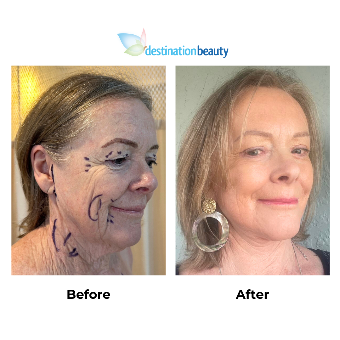 Janes 9 weeks post-facelift with Dr. Ring (3)