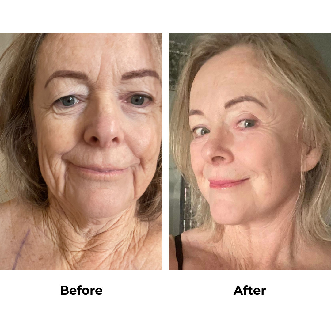 Janes MFNL, upper & lower eyelids, fat transfer to mouth Dr. Ring - 5 months