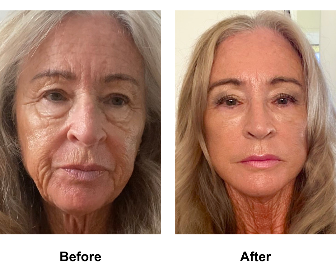 Janet had FFNL + LB + Fat Transfer to face - 4 months  (2)
