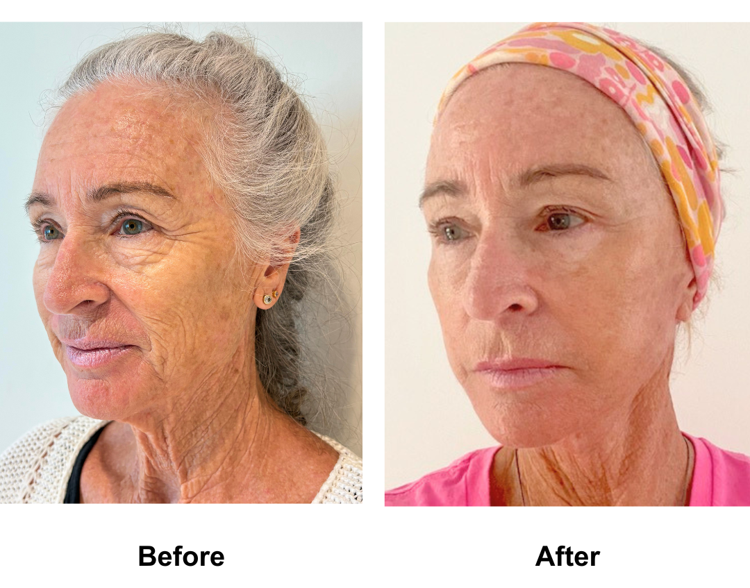 Janet had FFNL + LB + Fat Transfer to face - 8 months with Dr. NJ