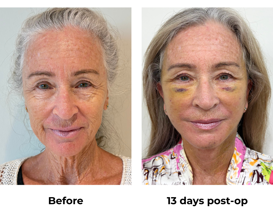 Janet had FFNL + LB + Fat Transfer to face with Dr. NJ (1)