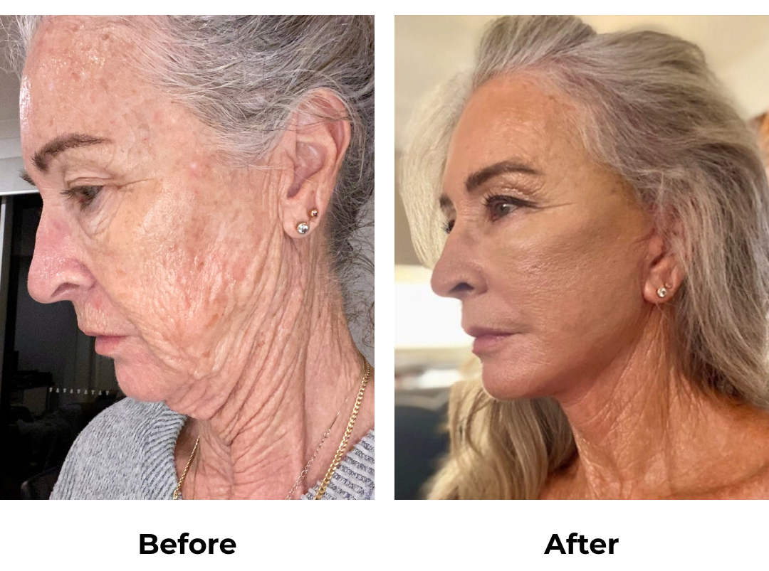 Janet had FFNL + LB + Fat Transfer to face with Dr. NJ (6)