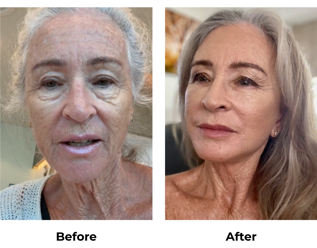 Janet had FFNL + LB + Fat Transfer to face with Dr. NJ (8)