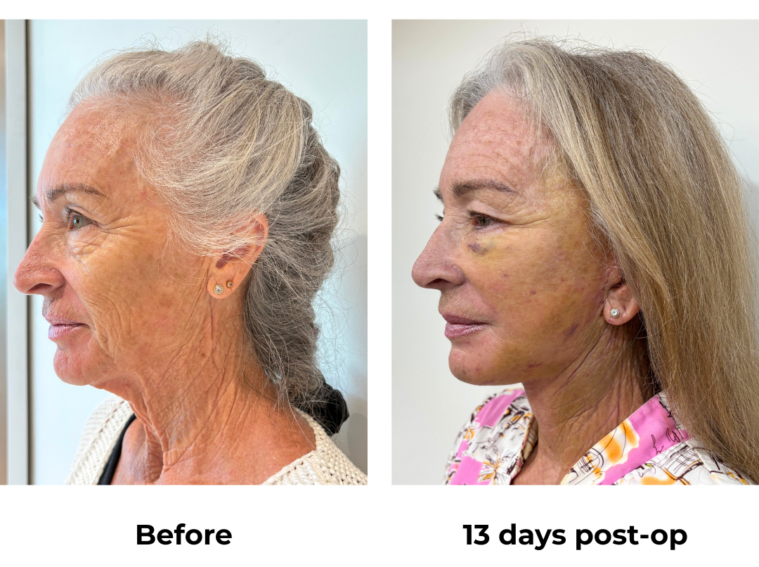 Janet had FFNL + LB + Fat Transfer to face with Dr. NJ