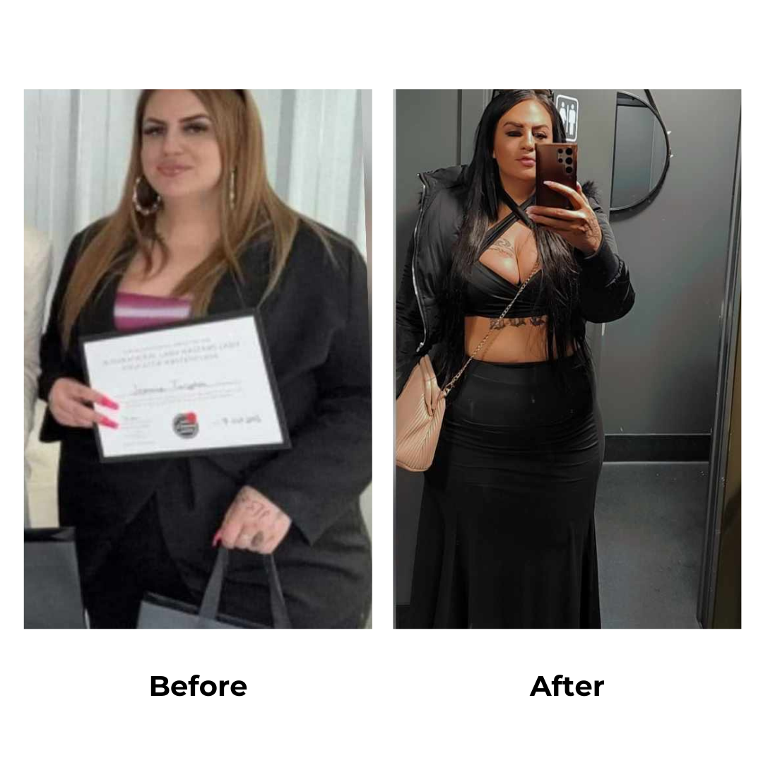 Jasmine had gastric sleeve surgery in Thailand