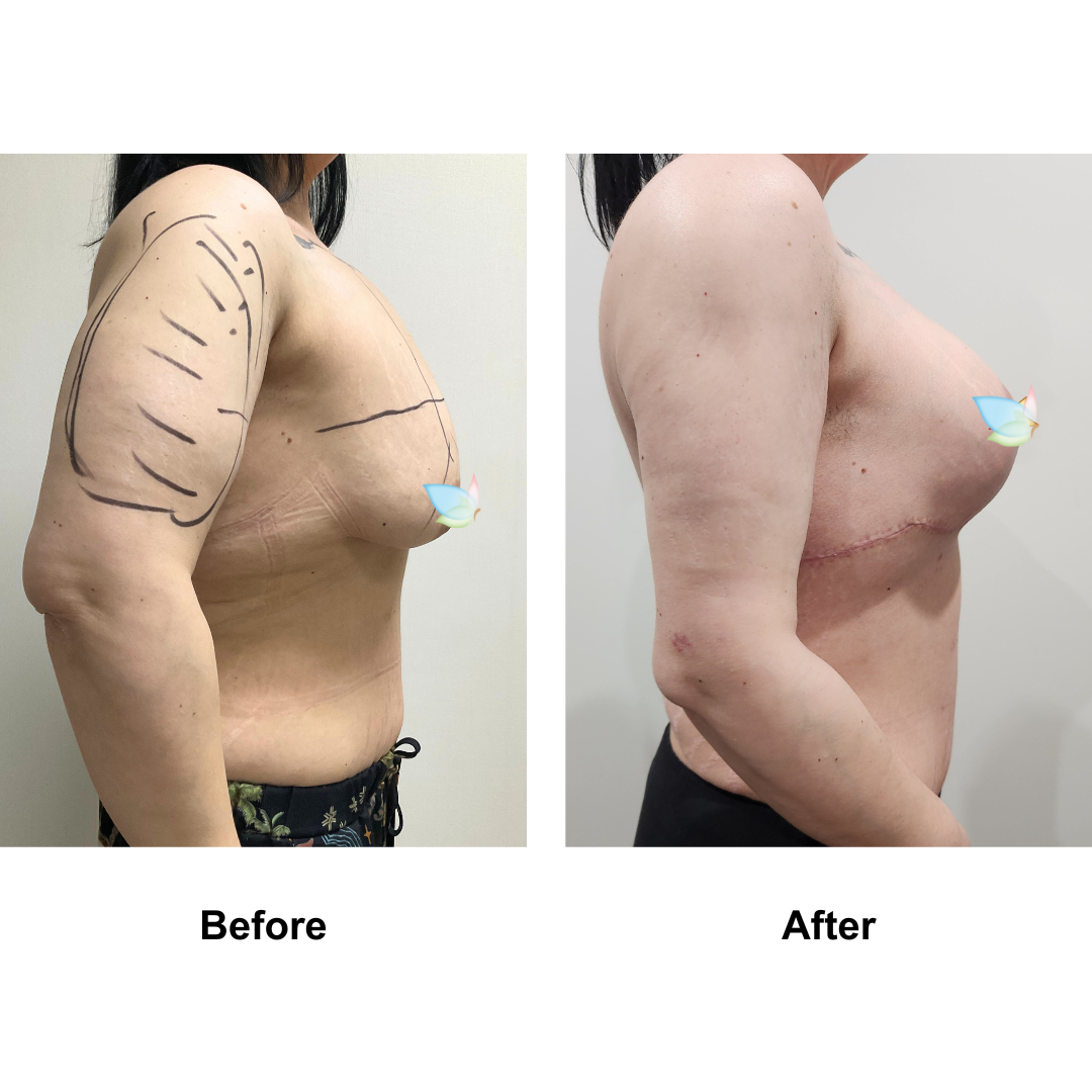 Jayne had AL + lipo _2 (inner arms and lower back) + Braline lift + BABL (2)