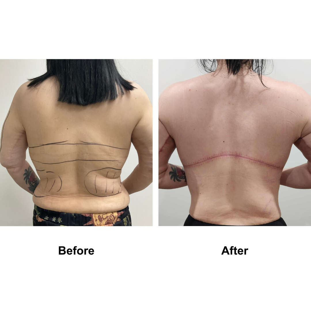 Jayne had AL + lipo _2 (inner arms and lower back) + Braline lift + BABL (3)