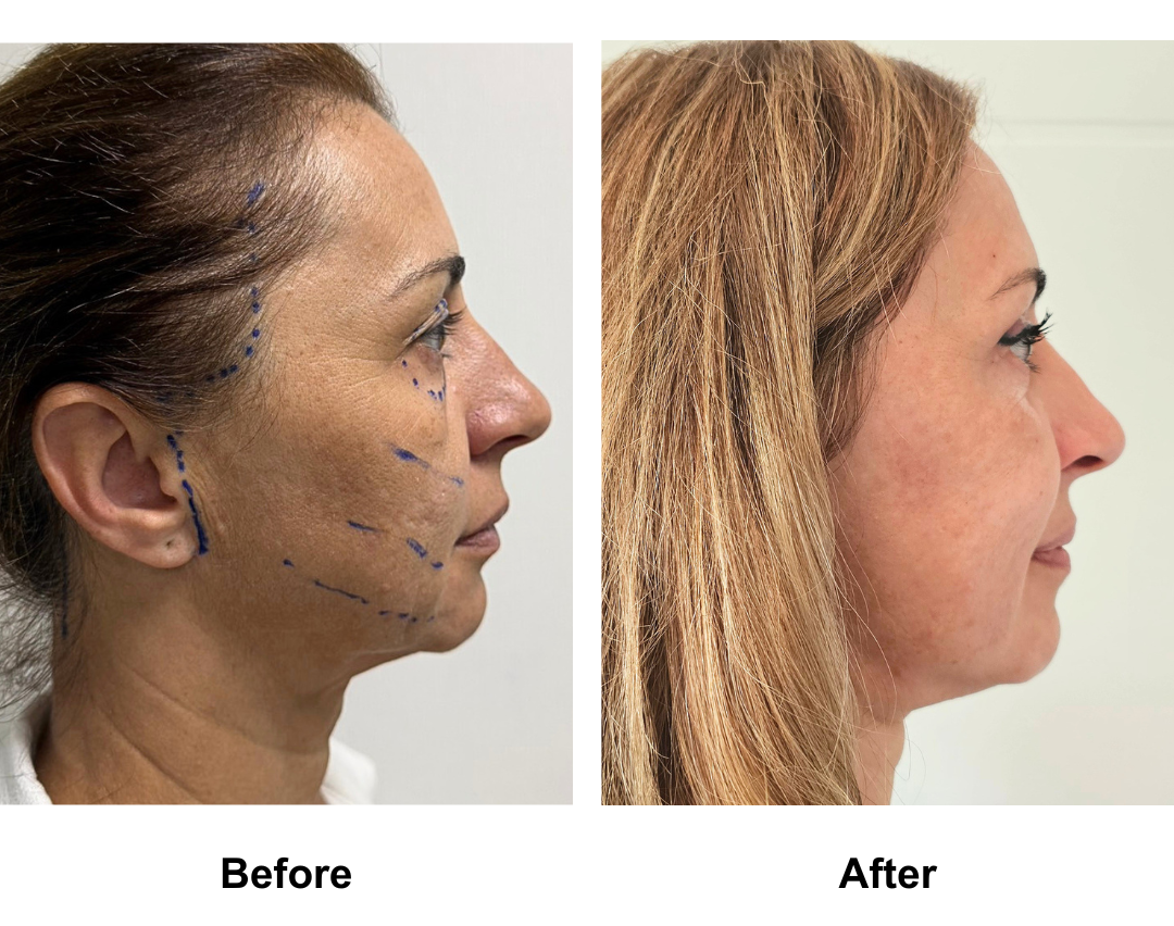 Jenna 51, had FFNL + UB +LB with Dr. Ring (2)