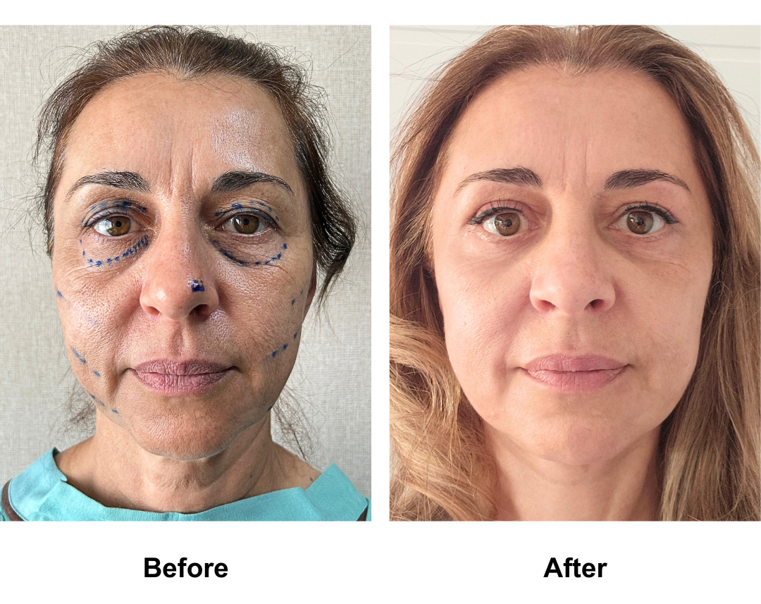 Jenna 51, had FFNL + UB +LB with Dr. Ring (3)