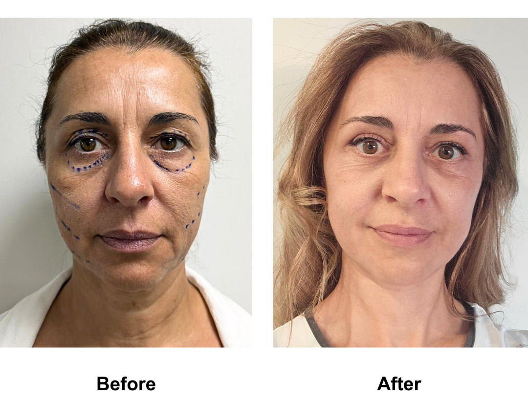 Jenna 51, had FFNL + UB +LB with Dr. Ring