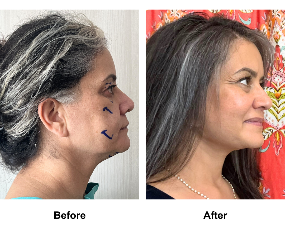 Jennifer had MFNL + Chin Lift + UB + LB + Endo forehead with Dr. Ring (2)