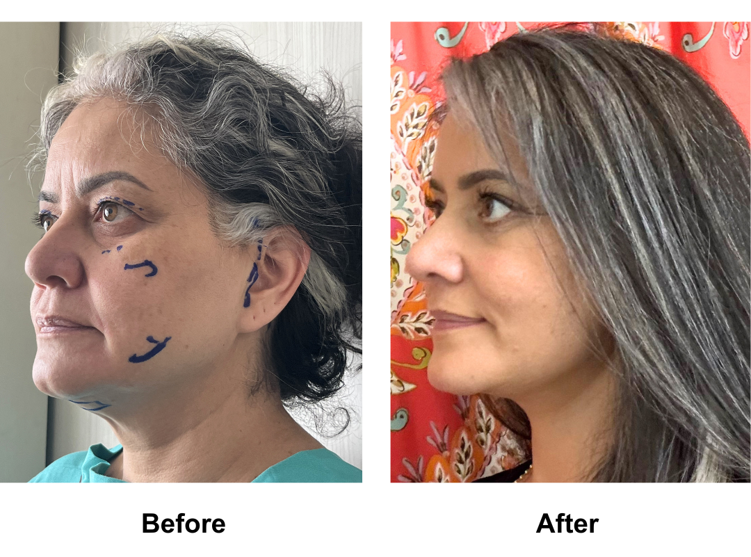Jennifer had MFNL + Chin Lift + UB + LB + Endo forehead with Dr. Ring (3)