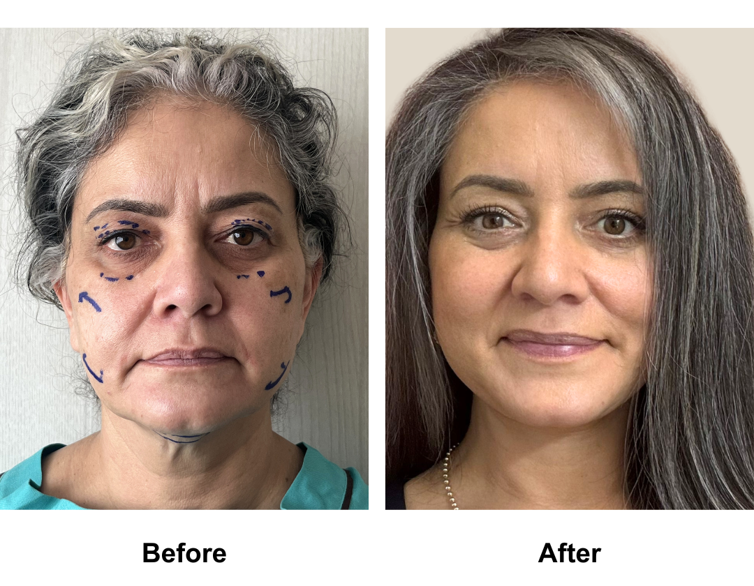 Jennifer had MFNL + Chin Lift + UB + LB + Endo forehead with Dr. Ring