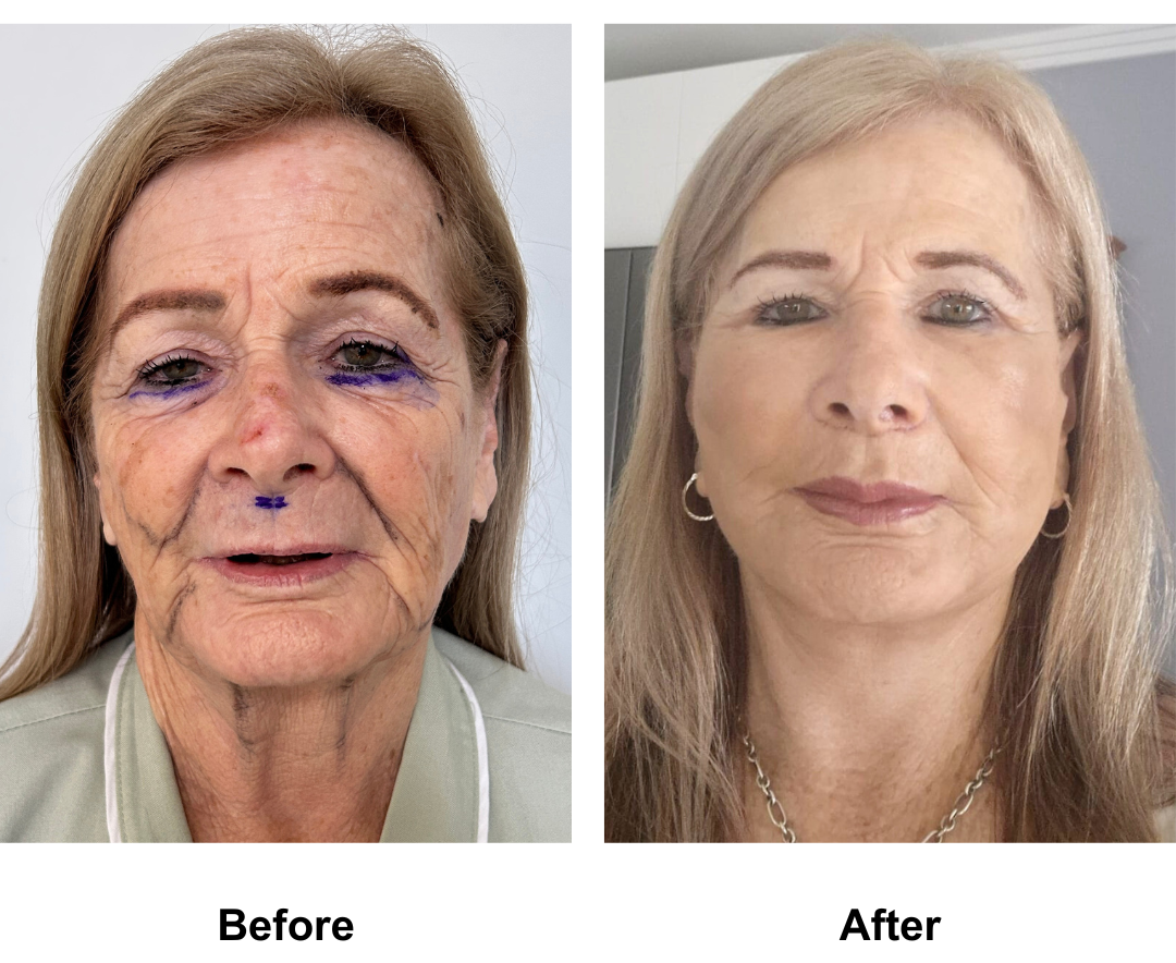 Jennifer had Rev. FFNL + Fat transfer to face + Plastymaplasty + Upper lip lift with Dr. Jatuporn (3)