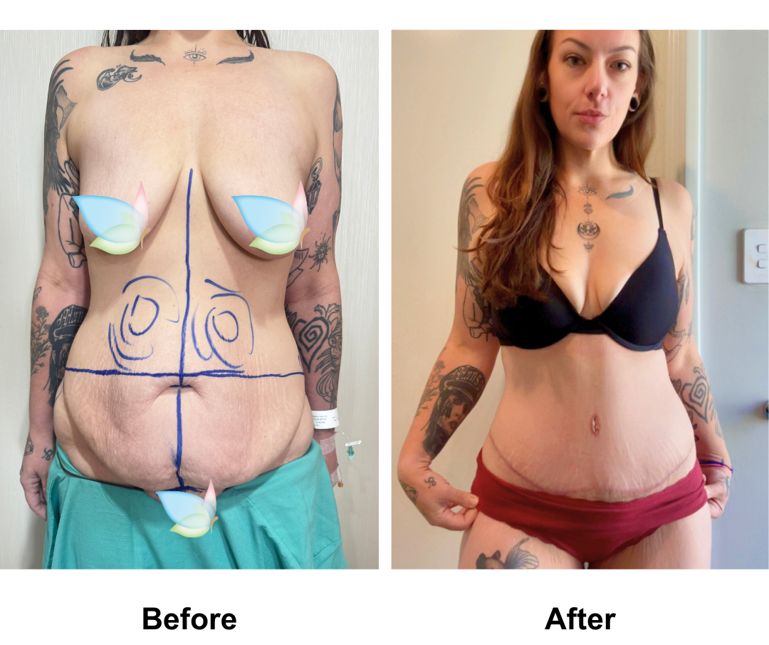 Jessica had ExTT + ML + Lipo2 (upper abs, love handles) with Dr. Angkana