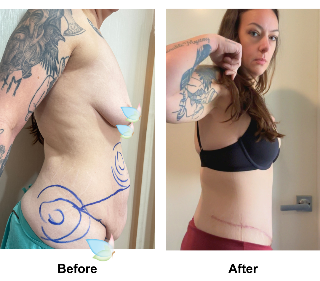 Jessica had ExTT + ML + Lipo_2 (upper abs, love handles) with Dr. Angkana (2)