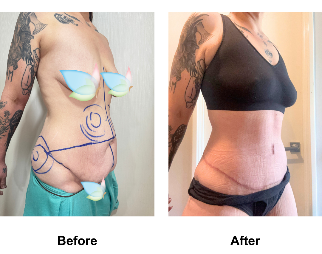 Jessica had ExTT + ML + Lipo_2 (upper abs, love handles) with Dr. Angkana