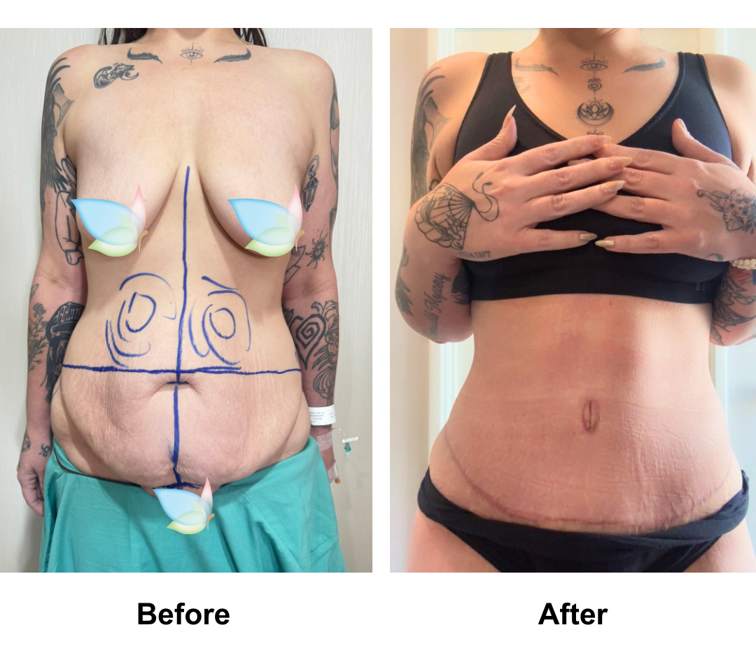 Jessica had ExTT + ML + Lipo_2 with Dr. Angkana - 6 weeks