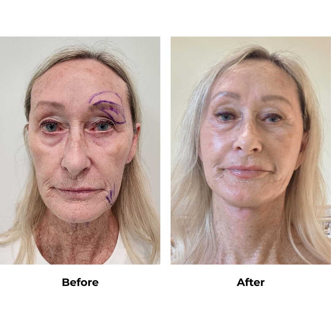 Jill had  MFNL + Fat transfer 2 areas (Mid cheek and marionette lines) with Dr. NJ (2)