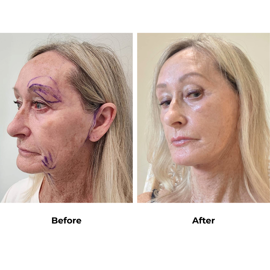 Jill had  MFNL + Fat transfer 2 areas (Mid cheek and marionette lines) with Dr. NJ (3)