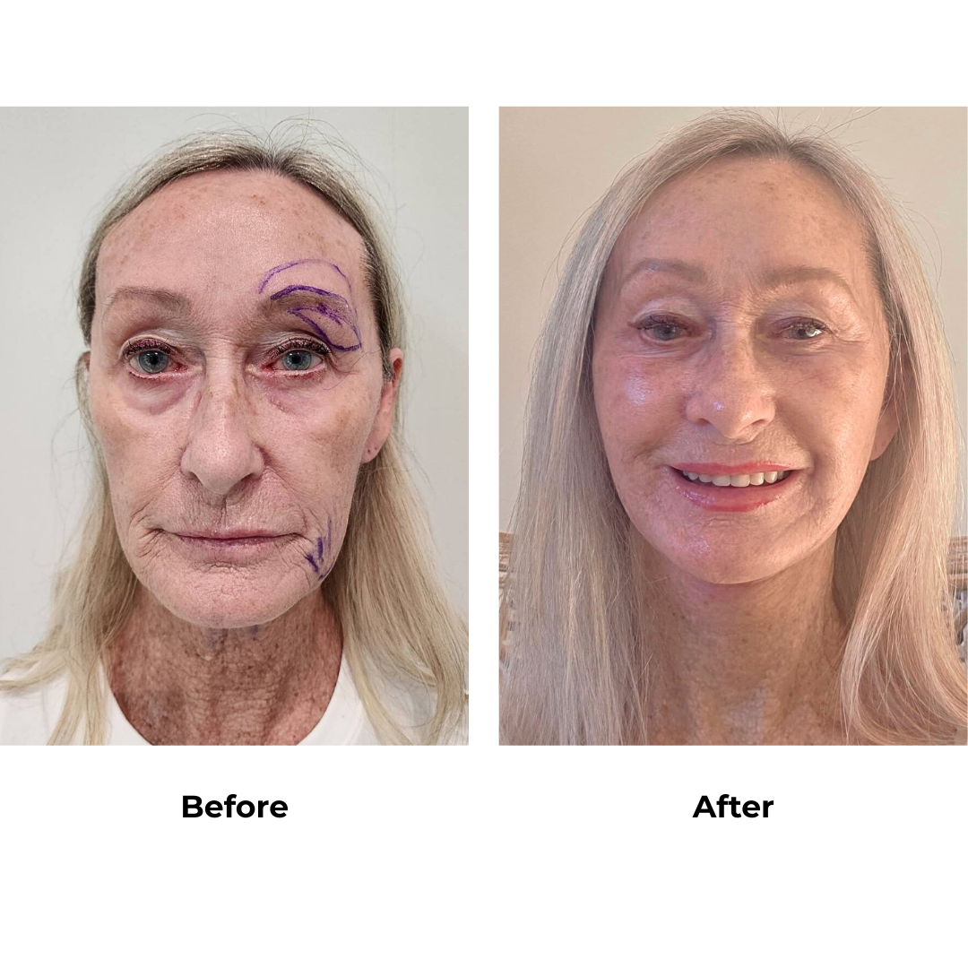 Jill had  MFNL + Fat transfer 2 areas (Mid cheek and marionette lines) with Dr. NJ