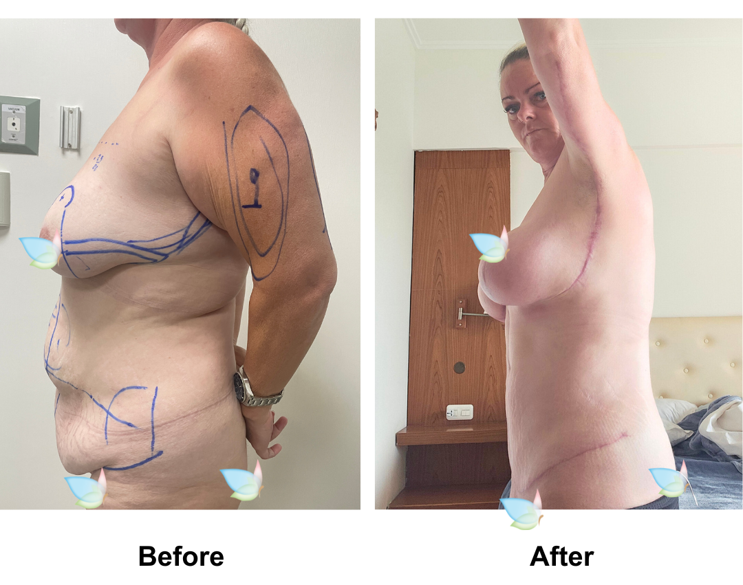 Jo had BABL (400 HP) + AL + Side Lift + Fleur de lis TT + VASER Lipo_3 + ML with Dr. K (2)