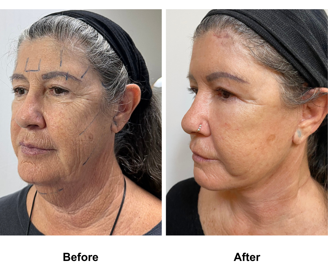 Jo, 65 had MFNL + Chin Lift + EBL with Dr. Ring (2)