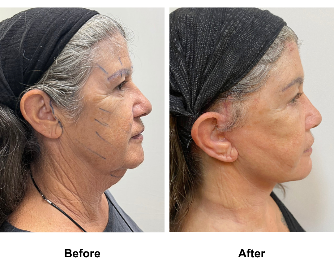 Jo, 65 had MFNL + Chin Lift + EBL with Dr. Ring (3)