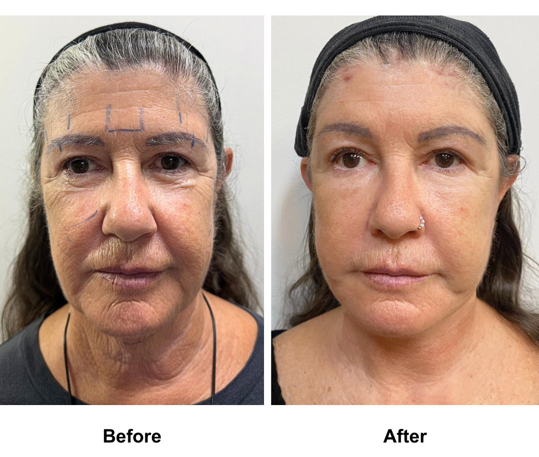 Jo, 65 had MFNL + Chin Lift + EBL with Dr. Ring