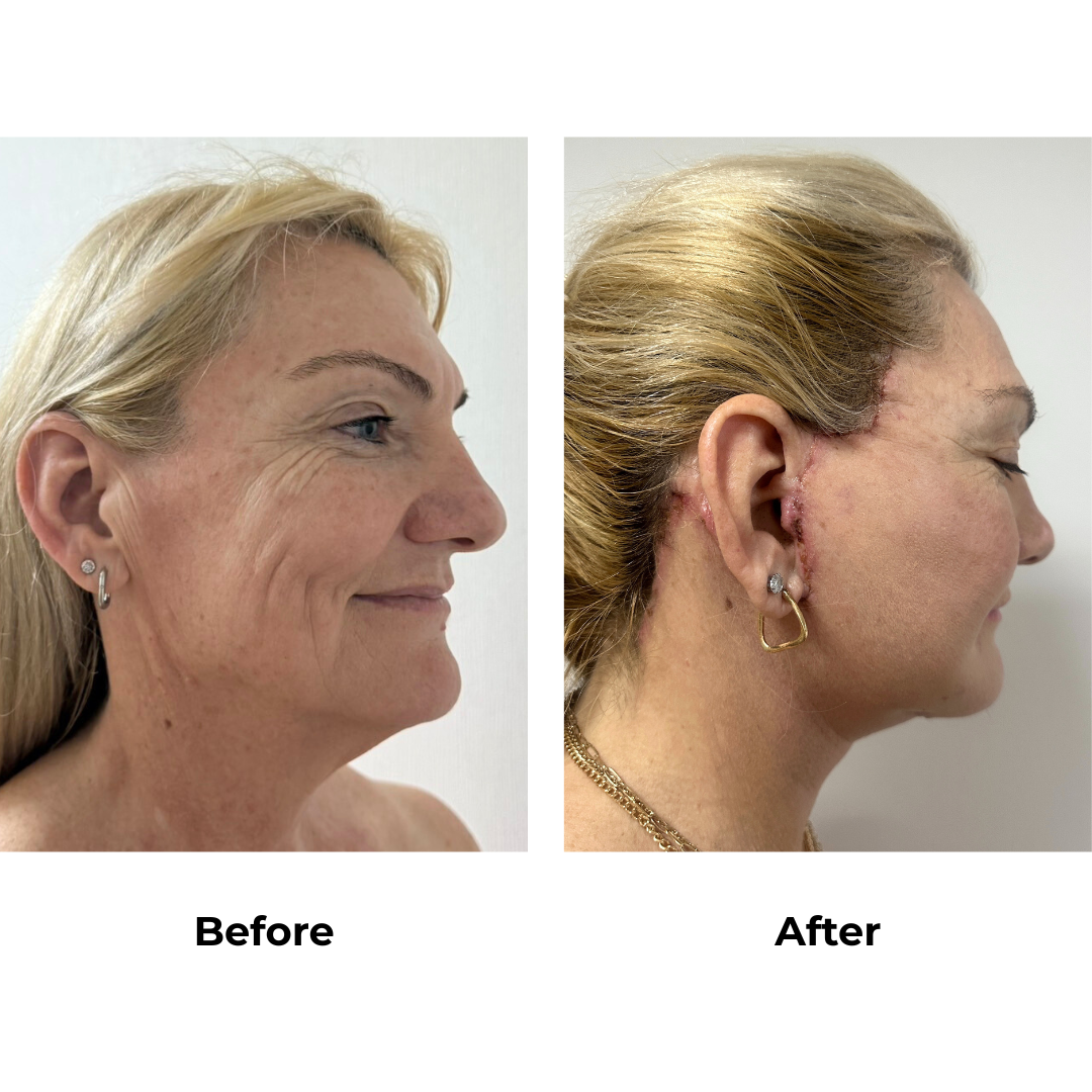 Joanna had MFNL + Chin lift with Dr. Ring (2)