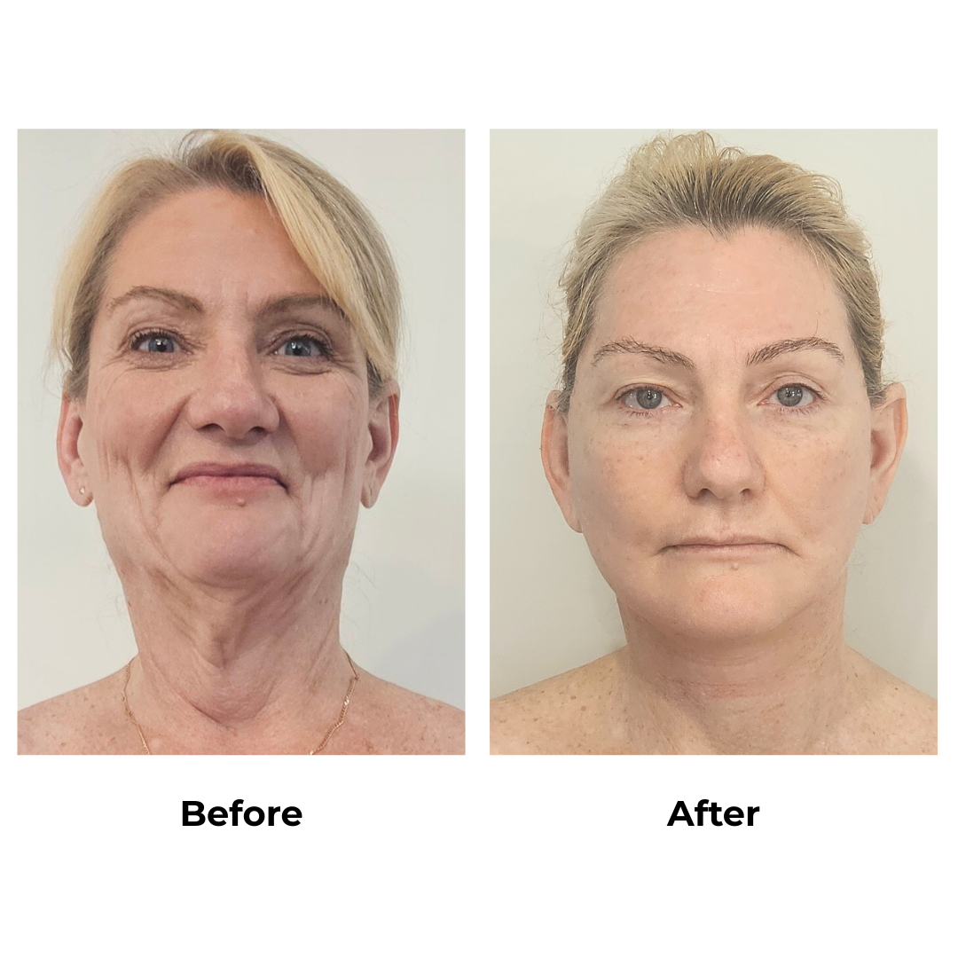Joanna had MFNL + Chin lift with Dr. Ring - 1 month (1)