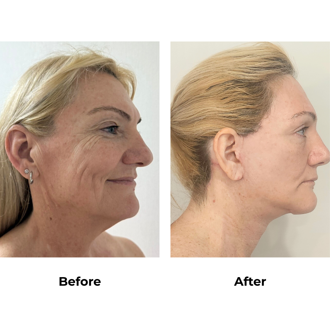 Joanna had MFNL + Chin lift with Dr. Ring - 1 month (2)