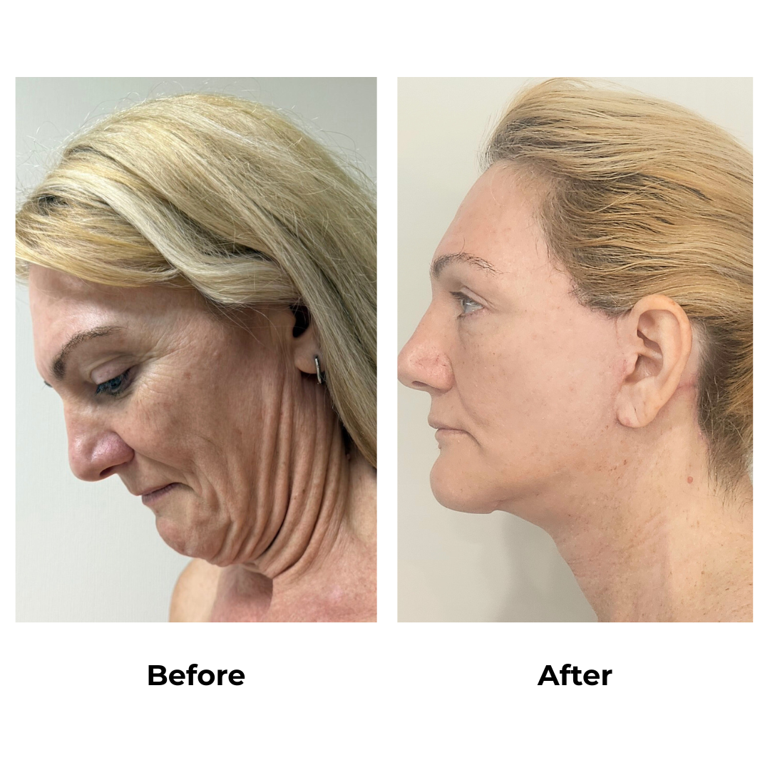 Joanna had MFNL + Chin lift with Dr. Ring - 1 month (4)