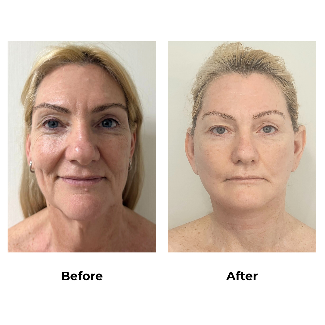 Joanna had MFNL + Chin lift with Dr. Ring - 1 month
