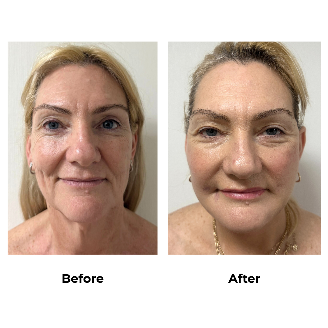Joanna had MFNL + Chin lift with Dr. Ring