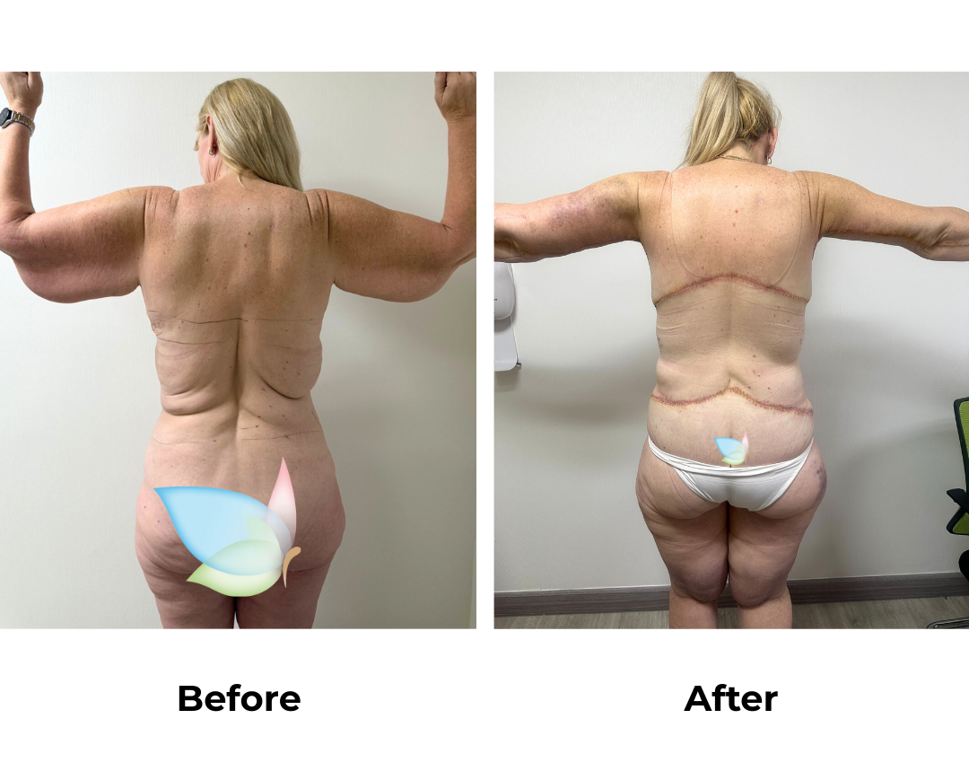 Joanna had Upper Back Lift + Circumferential TT + ML + Liposuction upper abdomen)  + Ex. AL + Lipo upper arms + Side Lift + BABL(250 CC)+ Nipple graft  + Lipo3 (Thigh) with Dr. Ring (1)