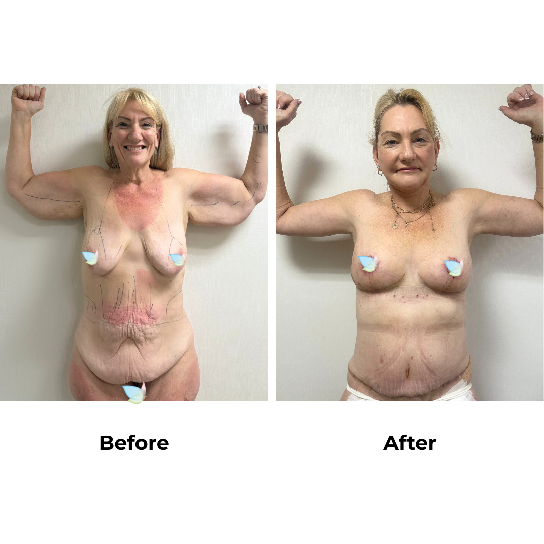 Joanna had Upper Back Lift + Circumferential TT + ML + Liposuction upper abdomen)  + Ex. AL + Lipo upper arms + Side Lift + BABL(250 CC)+ Nipple graft  + Lipo_3 (Thigh) with Dr. Ring (3)