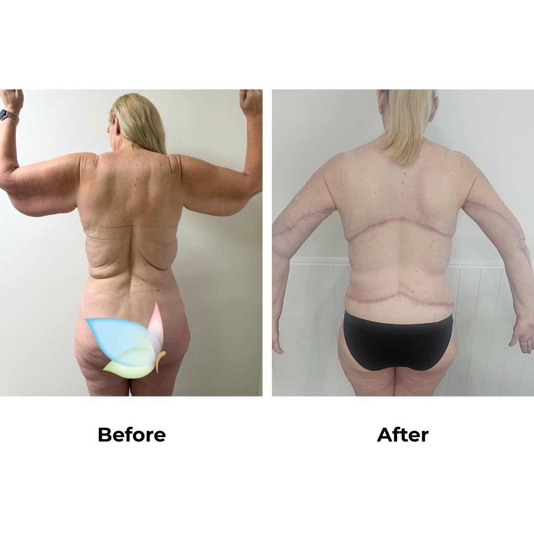 Joanna had Upper Back Lift + Circumferential TT + ML + Liposuction upper abdomen)  + Ex. AL + Lipo upper arms + Side Lift + BABL(250 CC)+ Nipple graft  + Lipo_3 (Thigh) with Dr. Ring - 1  month (2)