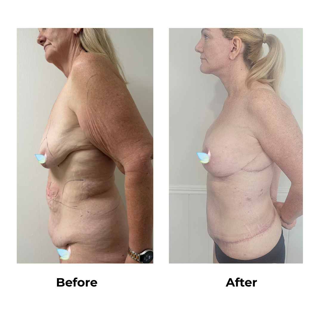 Joanna had Upper Back Lift + Circumferential TT + ML + Liposuction upper abdomen)  + Ex. AL + Lipo upper arms + Side Lift + BABL(250 CC)+ Nipple graft  + Lipo_3 (Thigh) with Dr. Ring - 1  month (3)