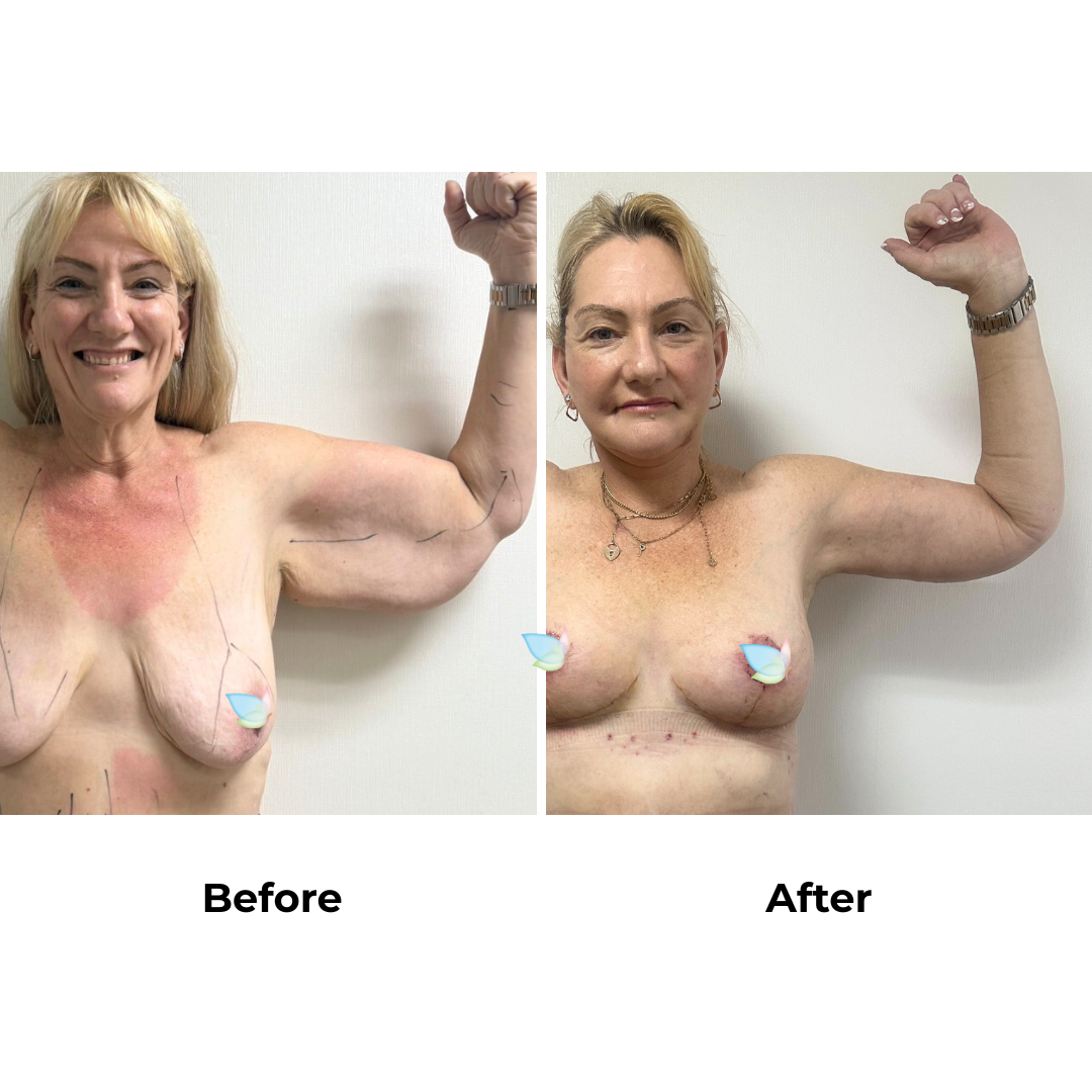 Joanna had Upper Back Lift + Circumferential TT + ML + Liposuction upper abdomen)  + Ex. AL + Lipo upper arms + Side Lift + BABL(250 CC)+ Nipple graft  + Lipo_3 (Thigh) with Dr. Ring