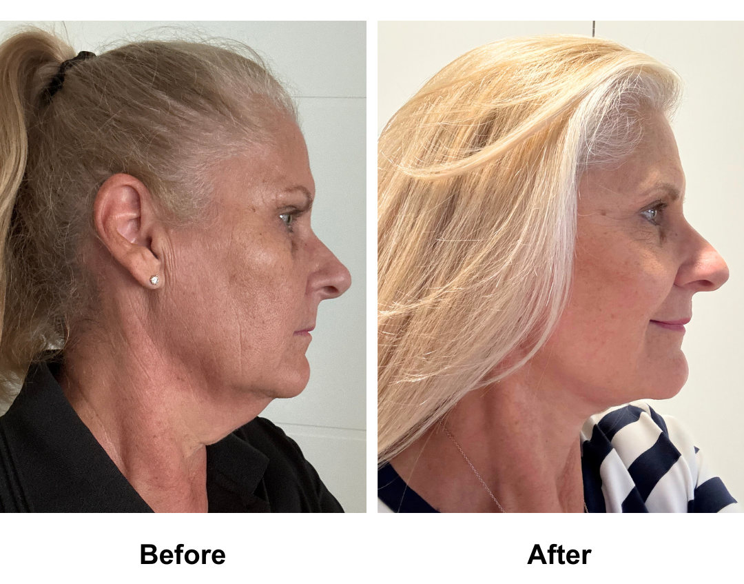 Joanne had MFNL  + Lipo chin +  Sub Brow Lift + Fat transfer to face with Dr. NJ (1)