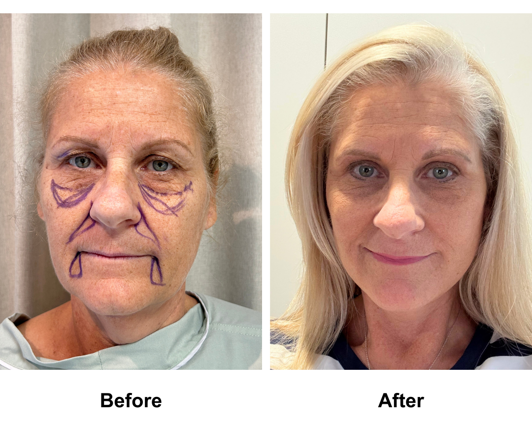 Joanne had MFNL  + Lipo chin +  Sub Brow Lift + Fat transfer to face with Dr. NJ (2)