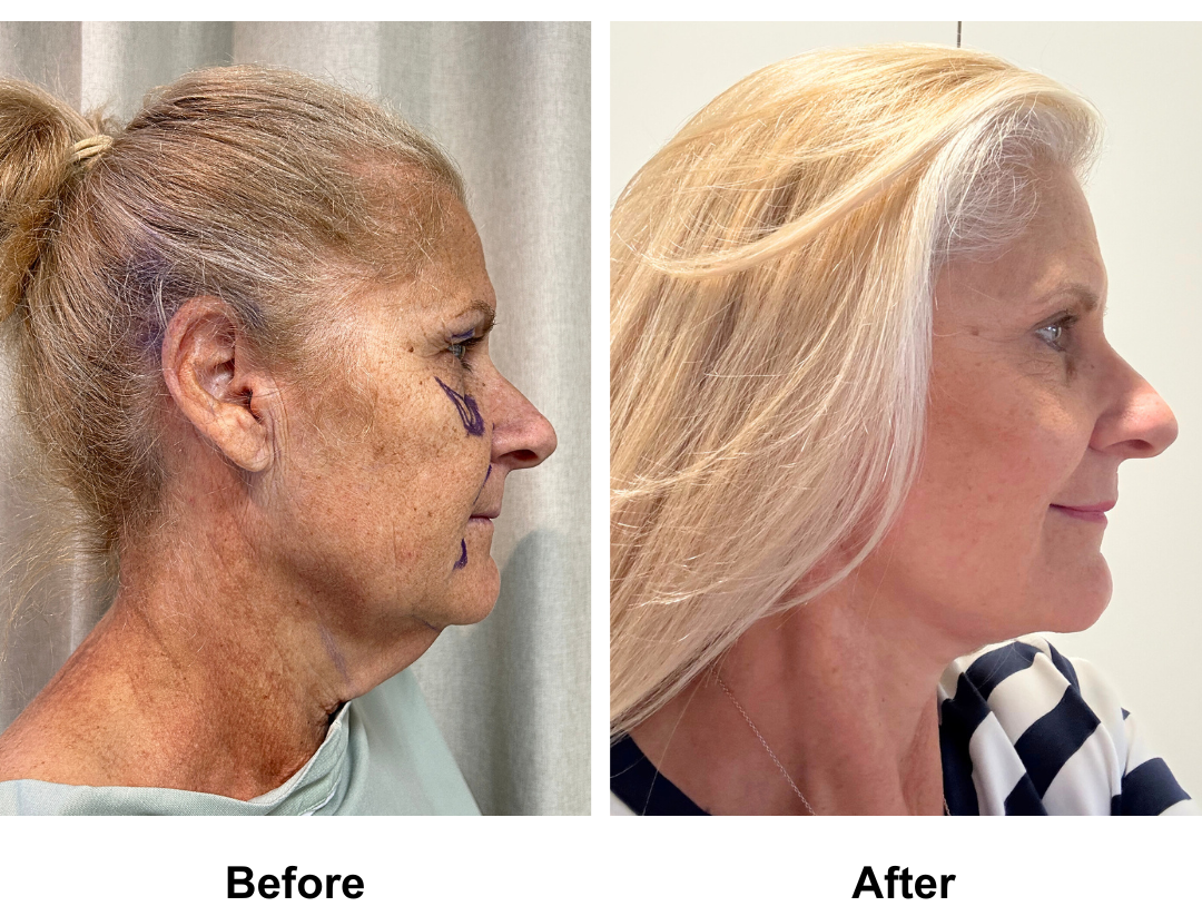 Joanne had MFNL  + Lipo chin +  Sub Brow Lift + Fat transfer to face with Dr. NJ (4)