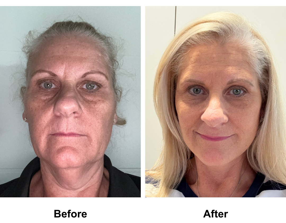 Joanne had MFNL  + Lipo chin +  Sub Brow Lift + Fat transfer to face with Dr. NJ