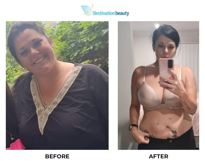 Joanne weight loss surgery 3