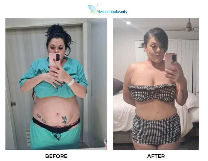 Joanne weight loss surgery 4