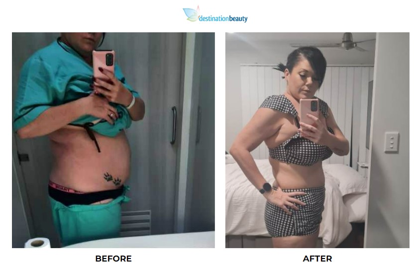 Joanne weight loss surgery 5